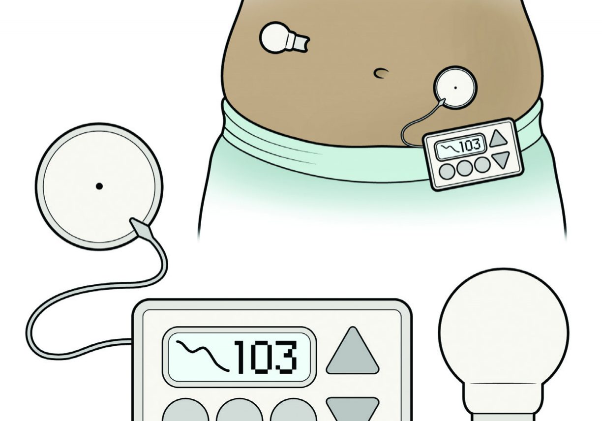 cgm